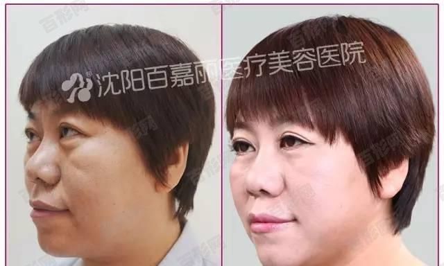 一針除皺多少錢美容外科中醫(yī)按療程來(lái)說(shuō)，一針除皺多少錢