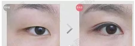 做准分子激光多钱？多大的机子多少钱？分析一下！