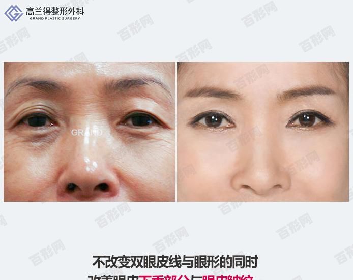 韩式双眼皮前后对比照片：韩式双眼皮能够做的更加宽更深