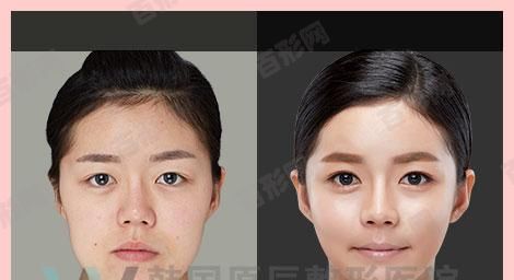 牙齒斷了只剩一點牙根，牙齒斷裂牙髓暴露可怎么辦？如何修復(fù)受損牙根