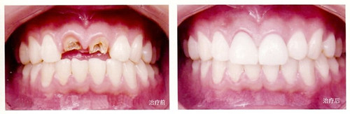 上海楊浦區(qū)口腔醫(yī)院價(jià)格表最新發(fā)布,上海楊浦區(qū)烤瓷牙醫(yī)院收費(fèi)標(biāo)準(zhǔn)都在這兒