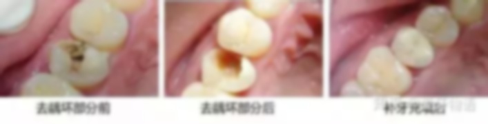 寶寶的牙齒腐蝕怎么辦?一歲寶寶牙齒腐蝕怎么補救?3歲寶寶牙齒腐蝕怎么補救? 寶寶的牙齒腐蝕怎么辦?一歲寶寶牙齒腐蝕怎么補救?3歲寶寶牙齒腐蝕怎么補救?