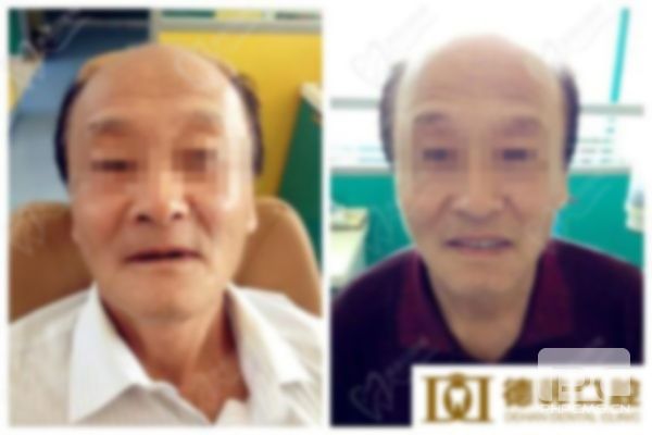 老人滿口活動假牙價格,老年人全口假牙價格,假牙的種類及價格