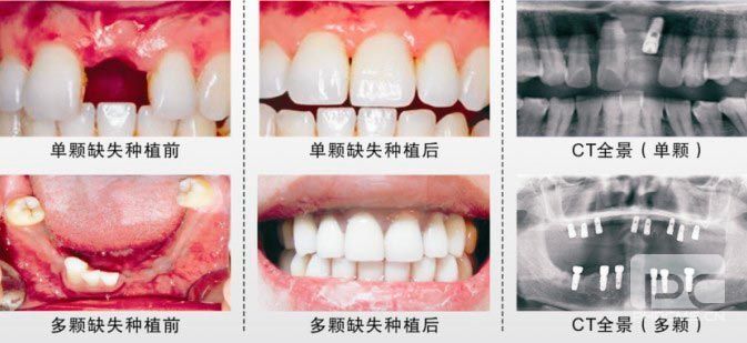 深圳龍華區(qū)口腔醫(yī)院收費價格,含啟飛|千喜口腔|正恩收費表