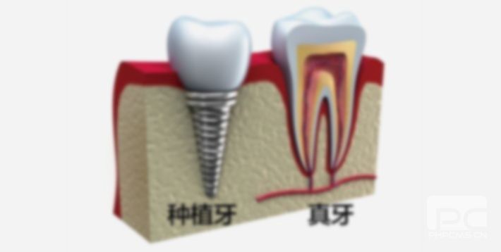 五十多歲有必要整牙嗎?五十歲能整牙嗎?五十歲還能整牙齒嗎?