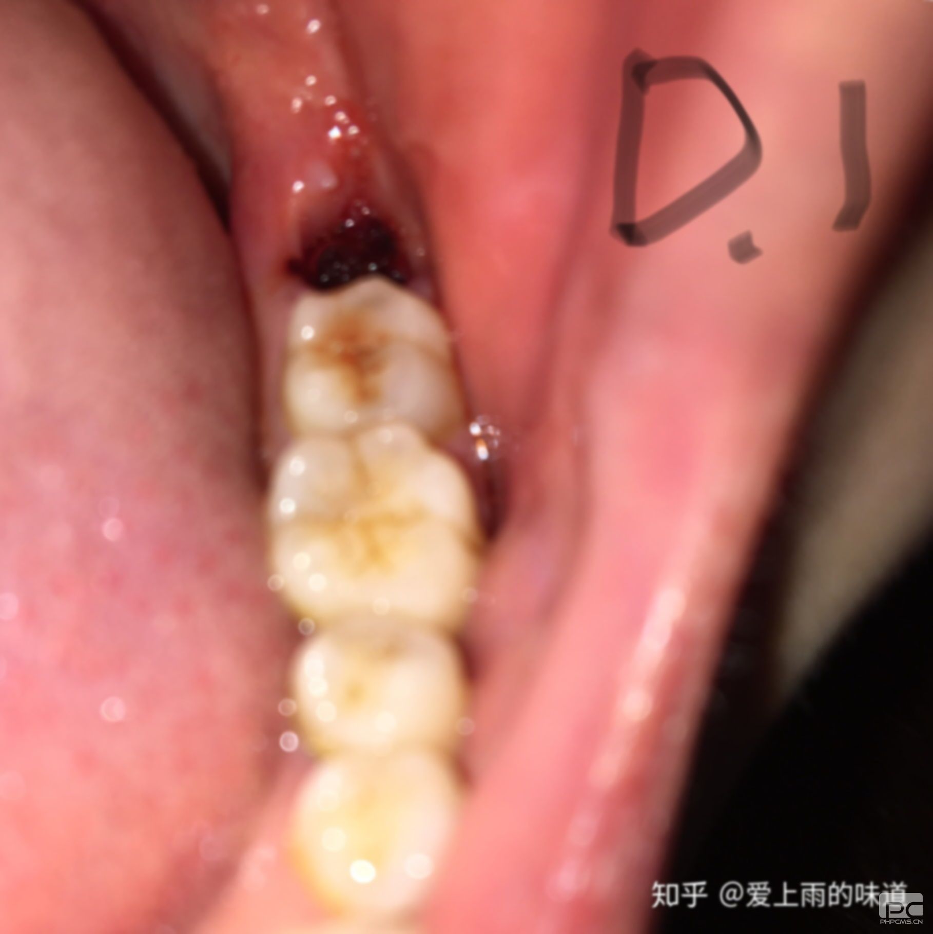 拔智齒的全過程,部過程,過程