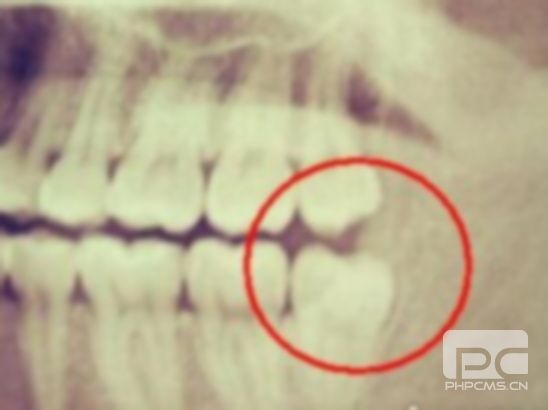 拔牙再箍牙有没有副作用,箍牙有什么后遗症?拔完牙可以箍牙吗?