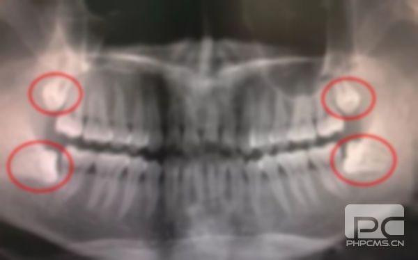 拔牙對別的牙有影響嗎?會(huì)對其他牙齒有影響嗎?以后對其他牙有影響嗎?