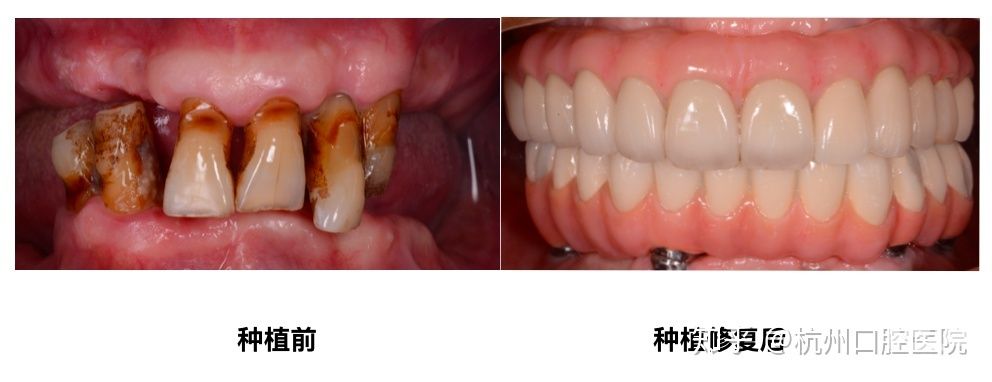 深圳福田區(qū)口腔醫(yī)院價(jià)格表新版揭露,深圳福田區(qū)烤瓷牙醫(yī)院收費(fèi)價(jià)格都在這兒