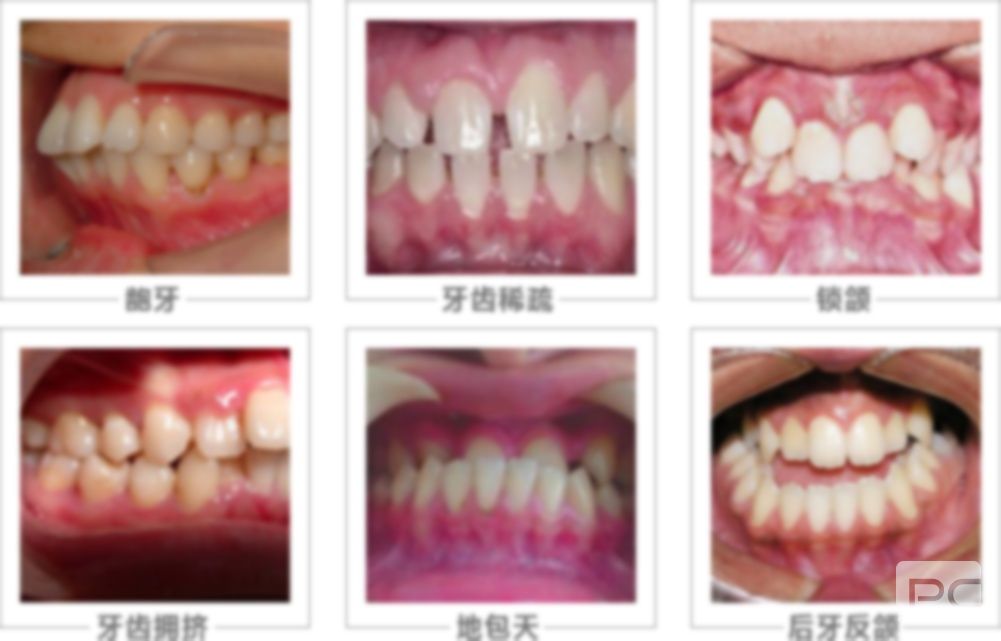 拔牙之后修復(fù)方法有幾種,后的修復(fù)方式,牙齒拔了修復(fù)的方式有幾種