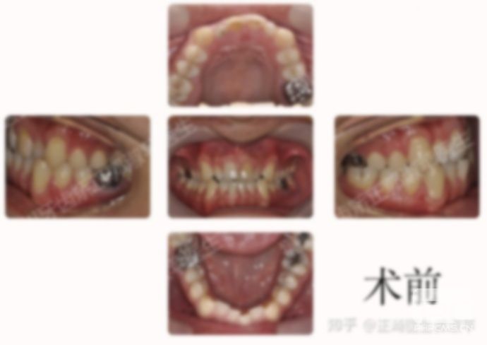 带牙套1 12月变化图,1到12月变化图,牙缝带牙套1~12月变化图