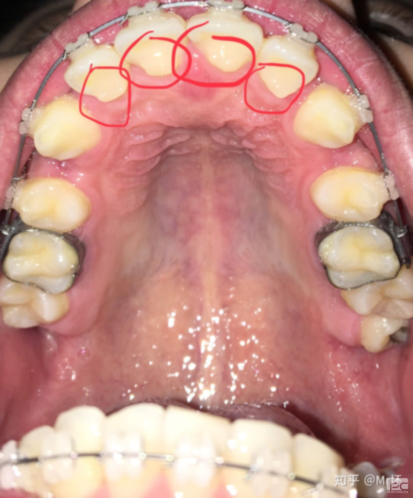 齙牙有辦法矯正嗎?能矯正嗎??可以矯正嗎??