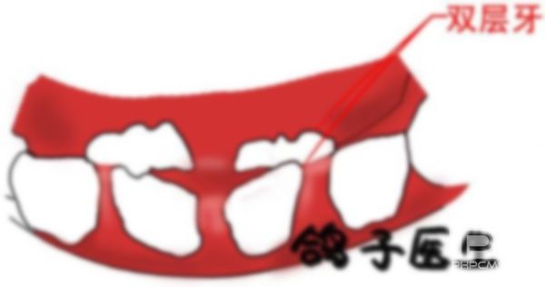 7歲門牙突出怎么辦?八歲孩子門牙突出怎么辦?8歲門牙外突出怎么辦圖片?
