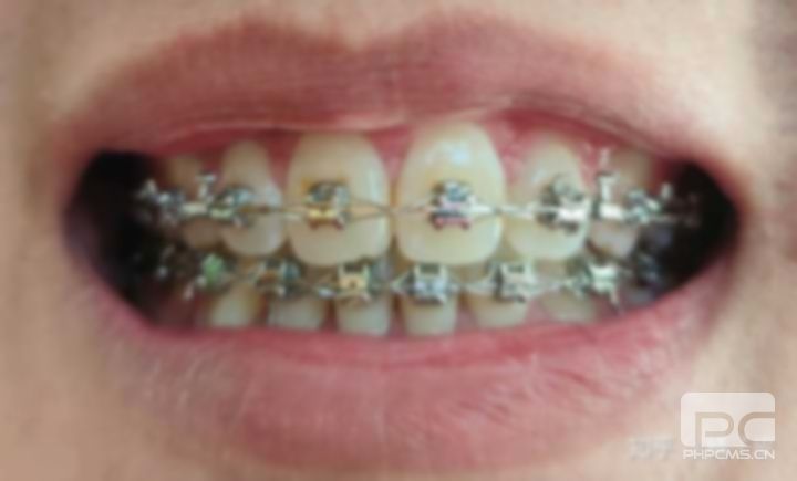 龅牙带牙套图片,牙缝带牙套1~12月变化图,拔牙带牙套1~12月变化图