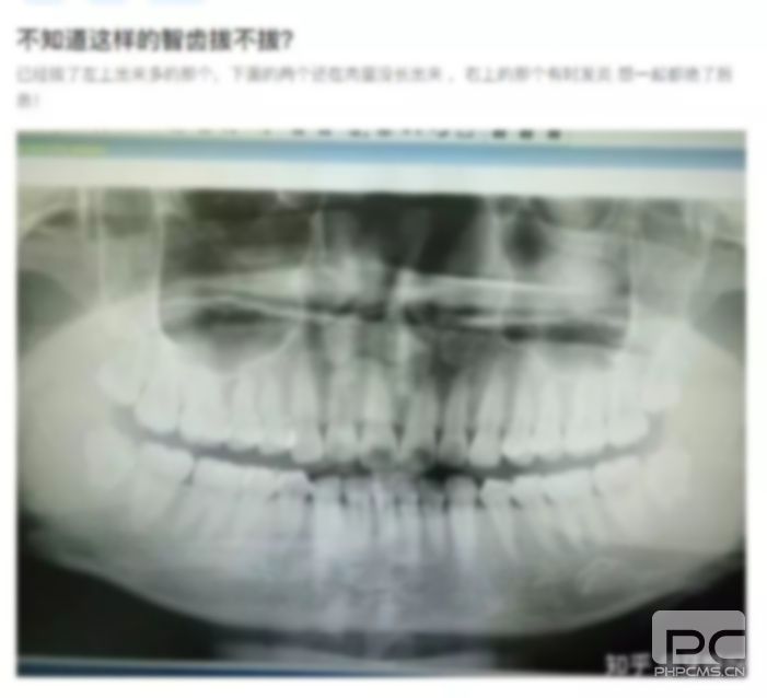 拔智齒拆線圖片,拆了線,自己拆線的步驟圖片