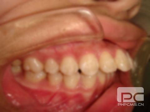 龅牙图片突出,男, 丑女