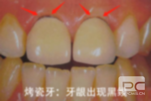 安装烤瓷牙需要多久时间,装烤瓷牙需要多久时间 安装烤瓷牙需要多久时间,装烤瓷牙需要多久时间