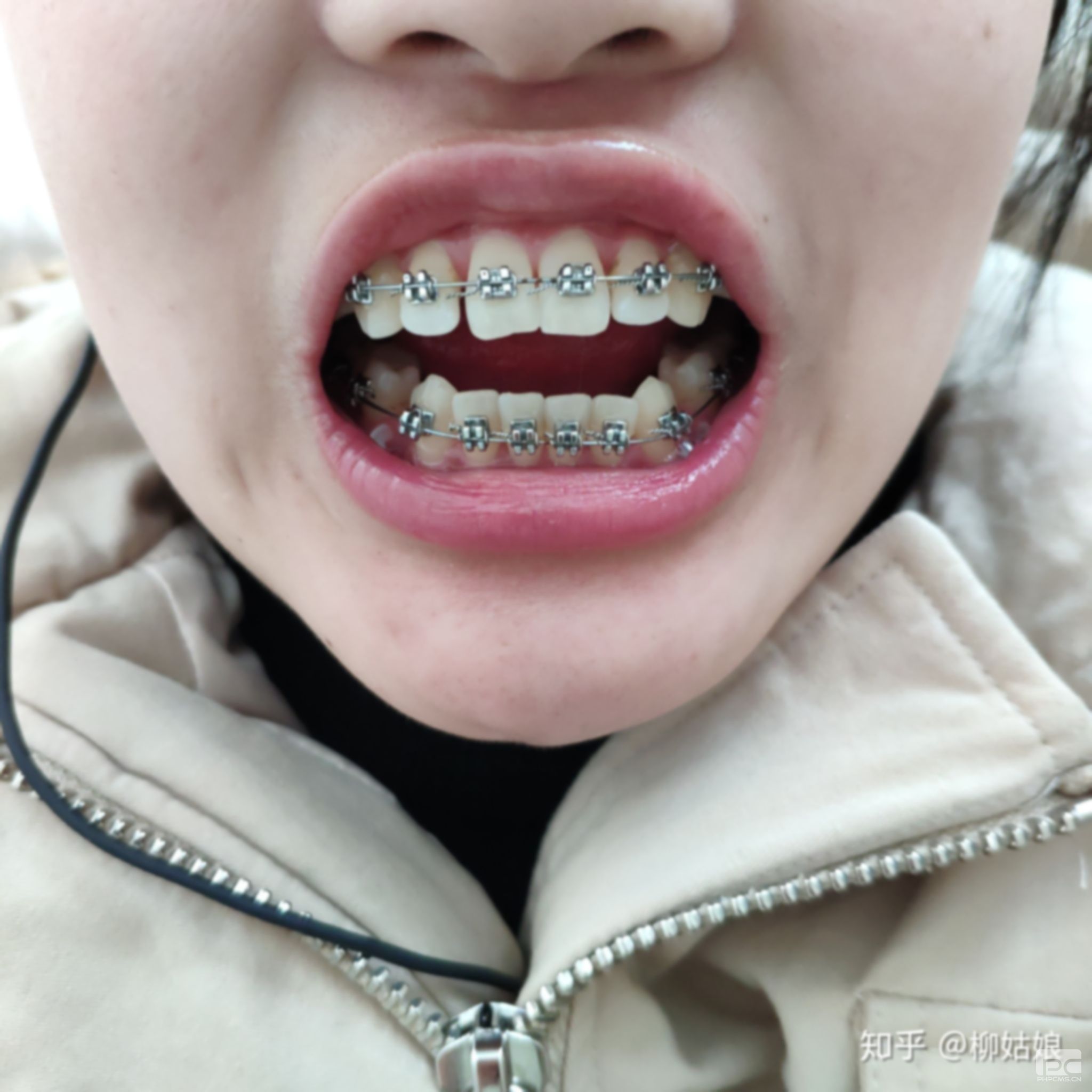 拔完牙后多久能戴牙套,牙后多久能戴牙套,多久能戴牙套