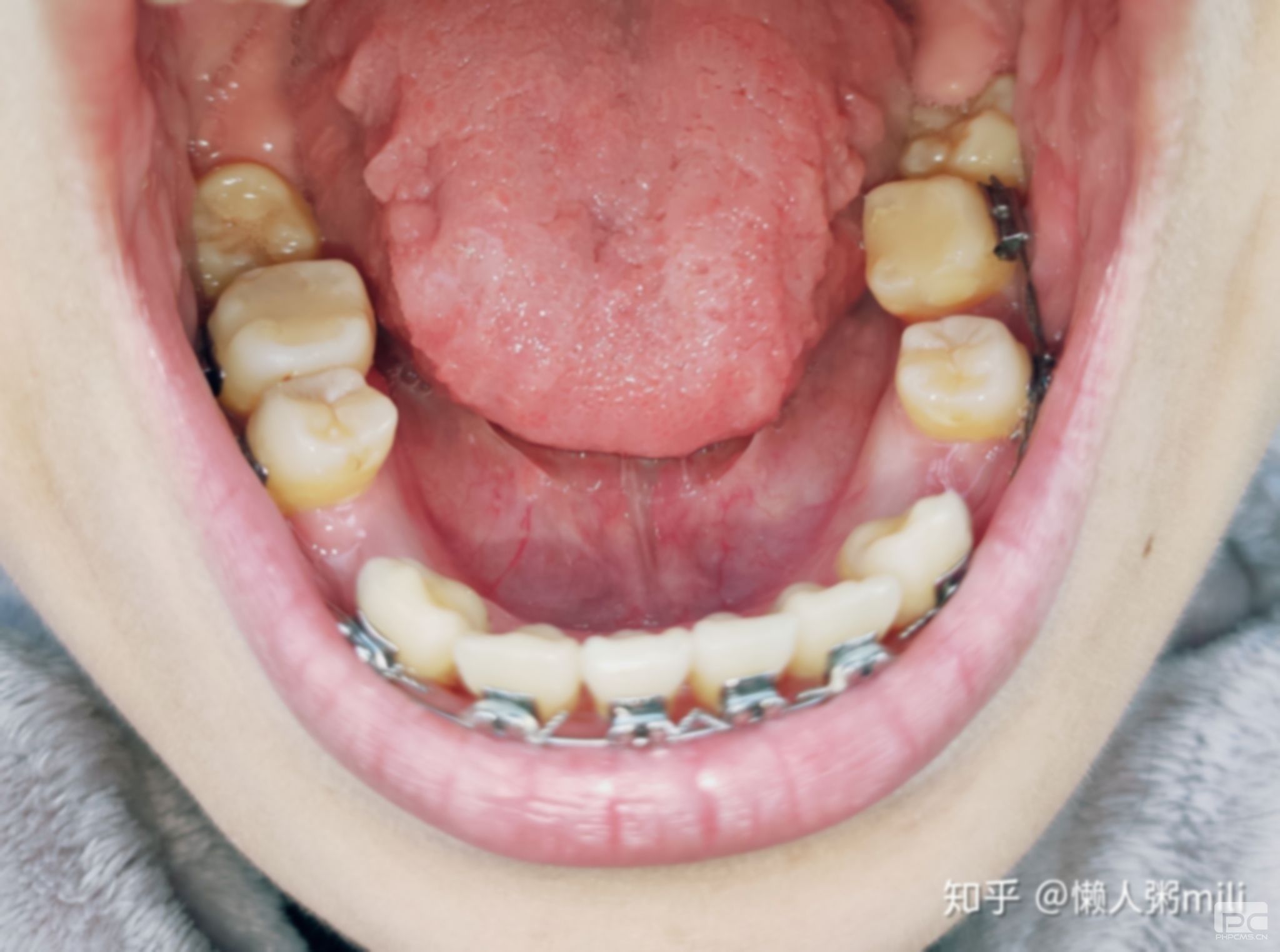 拔牙后多久可以做矯正?,拔完牙后多久可以做矯正,牙齒