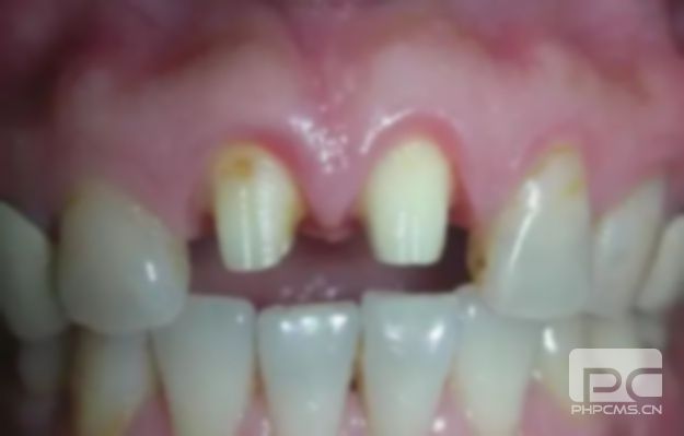 好牙磨小做烤瓷牙疼嗎?牙磨小后裝烤瓷牙疼嗎?做烤瓷牙之前磨牙疼嗎?