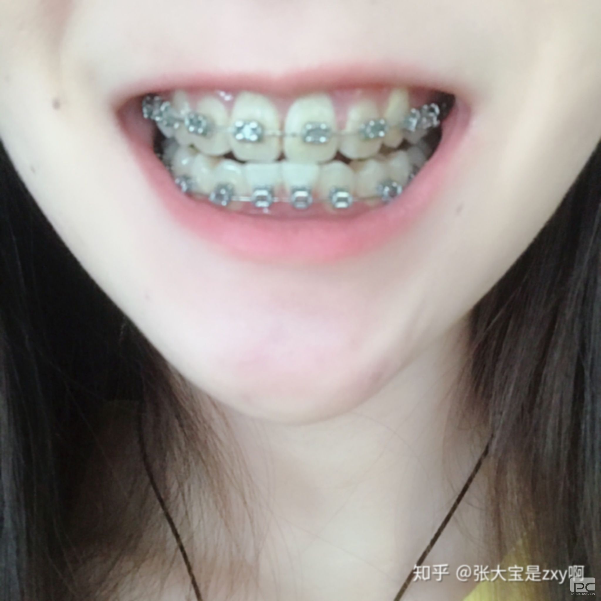 拔牙矯正牙齒臉會變小嗎?后矯正牙齒后臉會小嗎?整牙臉會變小嗎?