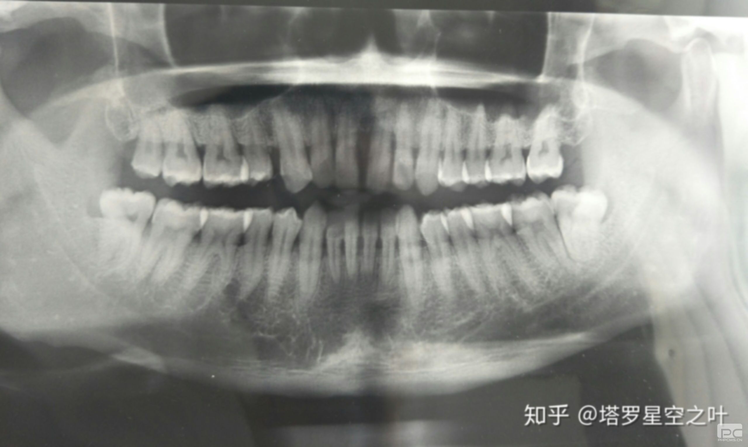 56歲牙齒脫落,掉牙齒正常嗎?55歲牙齒掉了