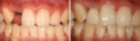 拔牙然后鑲牙多少錢(qián)?后鑲牙多少錢(qián)?后再鑲牙多少錢(qián)?