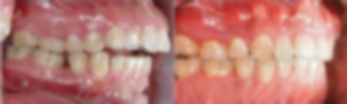 齙牙能通過(guò)拔牙改變嗎?糾正需要拔牙嗎?拔牙矯正的危害