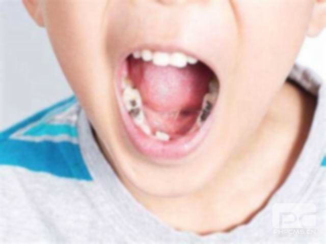 孩子的牙黑了怎么治療?牙黑了該怎么處理方法?兒童的牙黑了怎么辦?