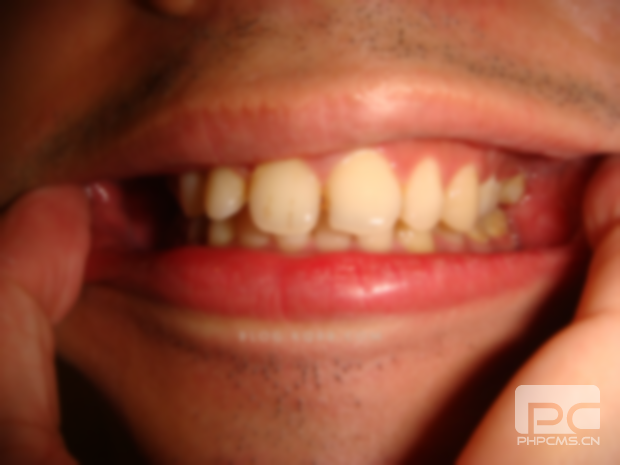 拔牙矫正牙齿会有什么后遗症??不会有什么后遗症或是牙床松动?以后有什么后遗症吗?