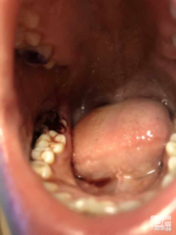 拔牙牙出血怎么止血?拔牙后出血怎么止血?拔牙之后出血怎么止血?