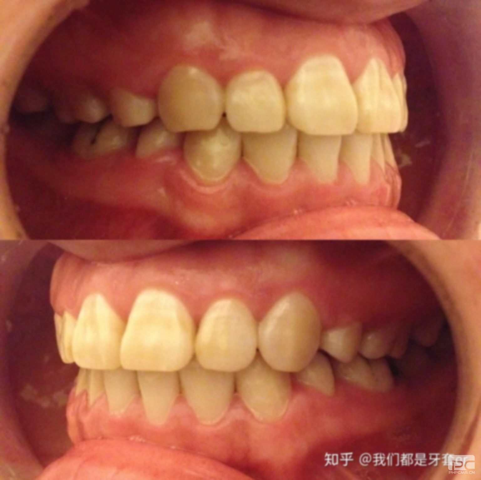 拔牙多久之后可以矯正,以后多久可以矯正,后能矯正