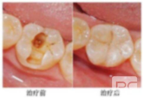 拔牙后七天窟窿恢復圖動漫,上牙拔牙后七天窟窿恢復圖,長平 拔牙后七天窟窿恢復圖動漫,上牙拔牙后七天窟窿恢復圖,長平