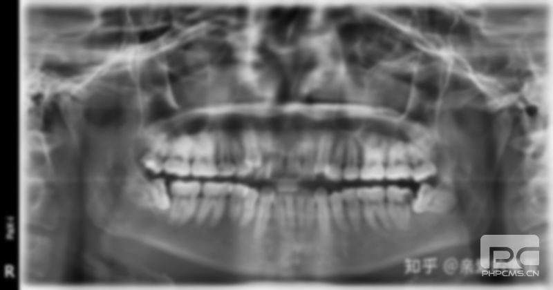 上海拔智齒多少錢一顆?拔智齒多少錢一顆牙?拔智齒多少錢一顆疼嗎?