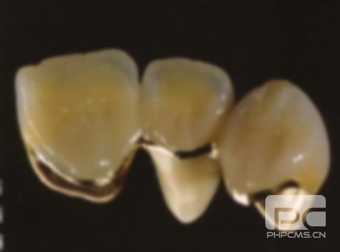 全瓷牙和烤瓷牙壽命一般多少年?全烤瓷牙和烤瓷牙壽命,半瓷牙壽命一般多少年? 全瓷牙和烤瓷牙壽命一般多少年?全烤瓷牙和烤瓷牙壽命,半瓷牙壽命一般多少年?