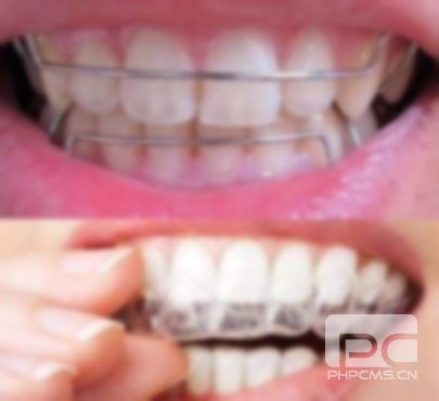 牙齒保持器要戴一輩子嗎?牙套保持器要戴一輩子嗎?戴保持器要戴一輩子嗎? 牙齒保持器要戴一輩子嗎?牙套保持器要戴一輩子嗎?戴保持器要戴一輩子嗎?