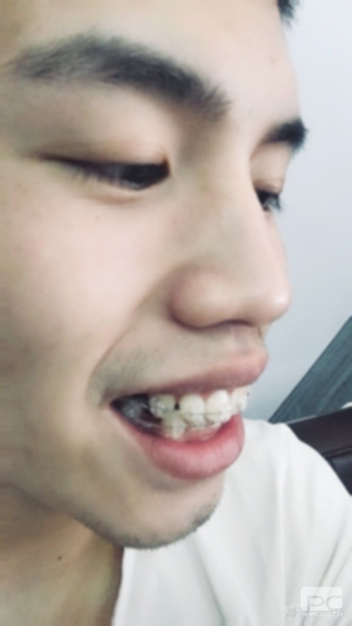 齙牙怎么緩解?治療最快?有什么辦法快速解決? 齙牙怎么緩解?治療最快?有什么辦法快速解決?