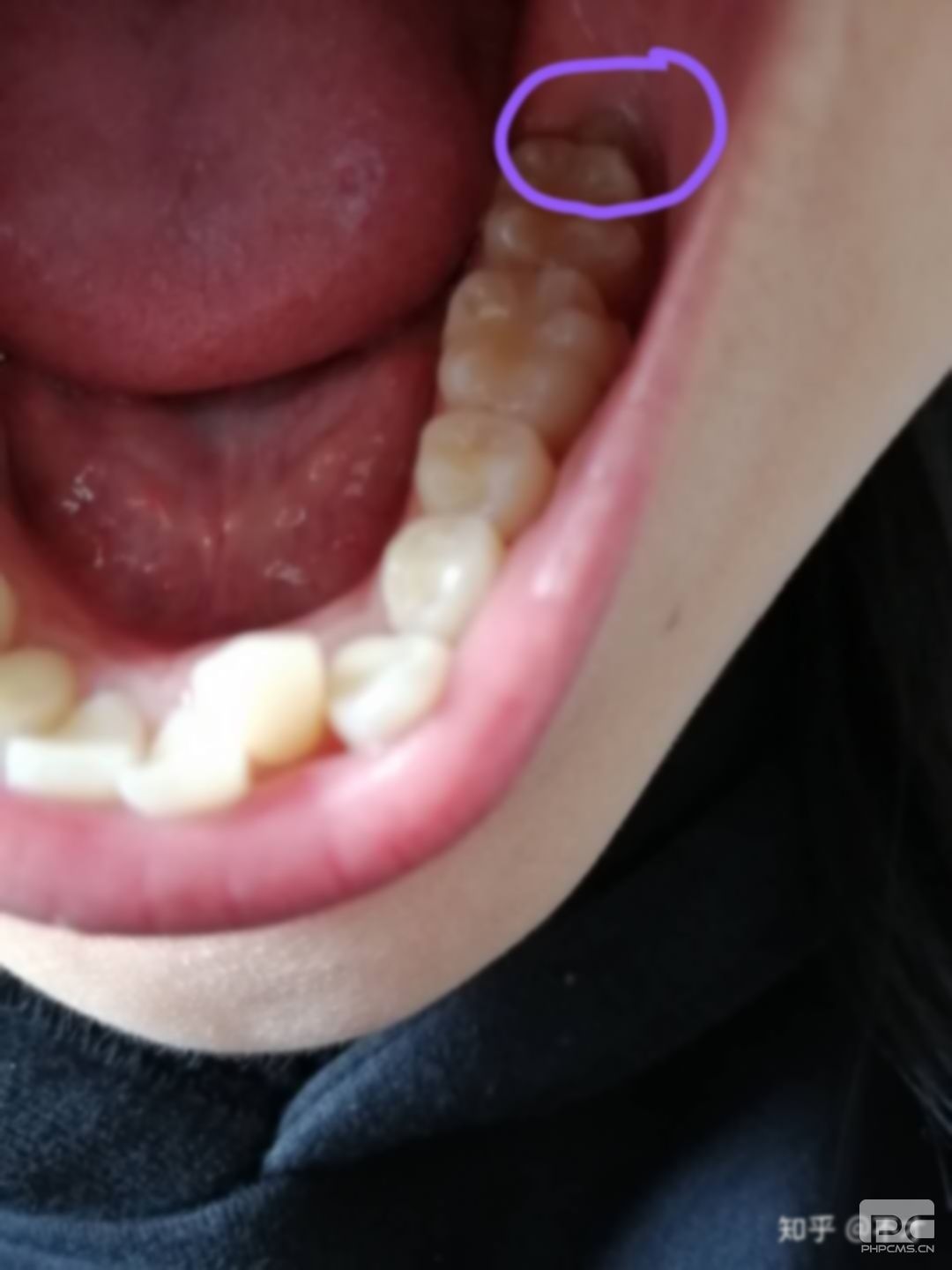 下門牙拔掉有什么危害?門牙拔掉有什么危害?拔下門牙有什么后果? 下門牙拔掉有什么危害?門牙拔掉有什么危害?拔下門牙有什么后果?