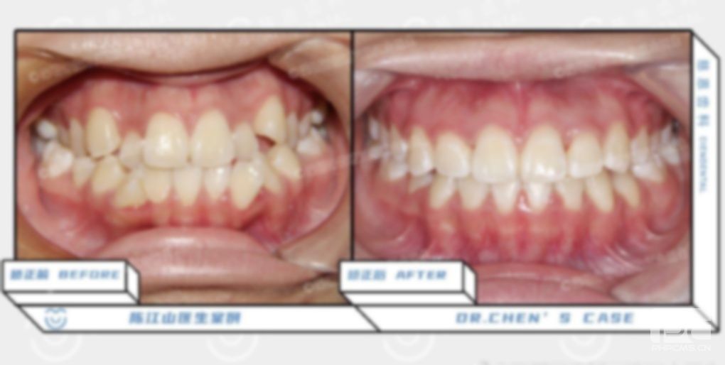 牙齒矯正完還會凸嘴嗎?拔牙能矯正嘴凸嗎?嘴凸一定要拔牙嗎? 牙齒矯正完還會凸嘴嗎?拔牙能矯正嘴凸嗎?嘴凸一定要拔牙嗎?