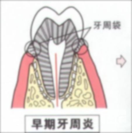 40歲 牙齒,牙齒就不好了,牙齒越來(lái)越突出 40歲 牙齒,牙齒就不好了,牙齒越來(lái)越突出