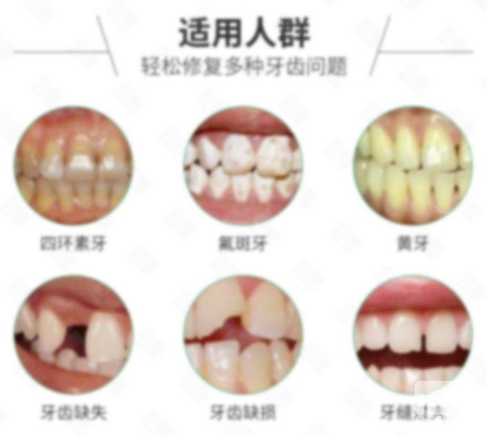 愛(ài)爾創(chuàng)全瓷牙怎么辨別真假?有假的嗎?1000元 愛(ài)爾創(chuàng)全瓷牙怎么辨別真假?有假的嗎?1000元