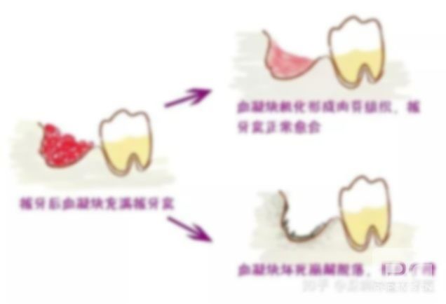 拔牙后嘴巴里都是血也不能吐嗎?嘴里的血塊能吐嗎?嘴里血塊要吐掉嗎? 拔牙后嘴巴里都是血也不能吐嗎?嘴里的血塊能吐嗎?嘴里血塊要吐掉嗎?