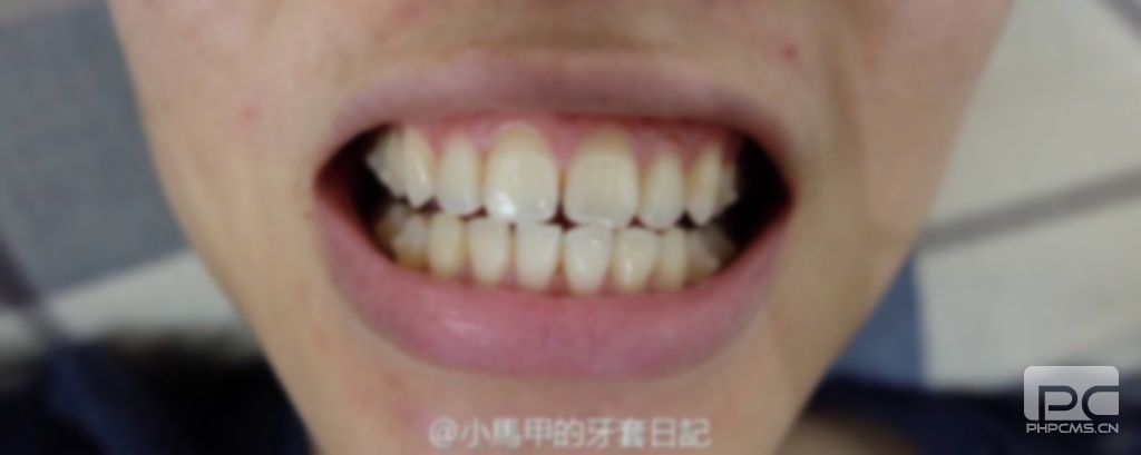 30多了還可以矯正牙齒嗎?30以后還可以矯正牙齒嗎?歲了還能矯正牙齒嗎? 30多了還可以矯正牙齒嗎?30以后還可以矯正牙齒嗎?歲了還能矯正牙齒嗎?