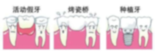 60歲以上老人種牙好還是鑲牙好?,80歲老人種牙好還是鑲牙好,老人是種牙還是鑲牙 60歲以上老人種牙好還是鑲牙好?,80歲老人種牙好還是鑲牙好,老人是種牙還是鑲牙