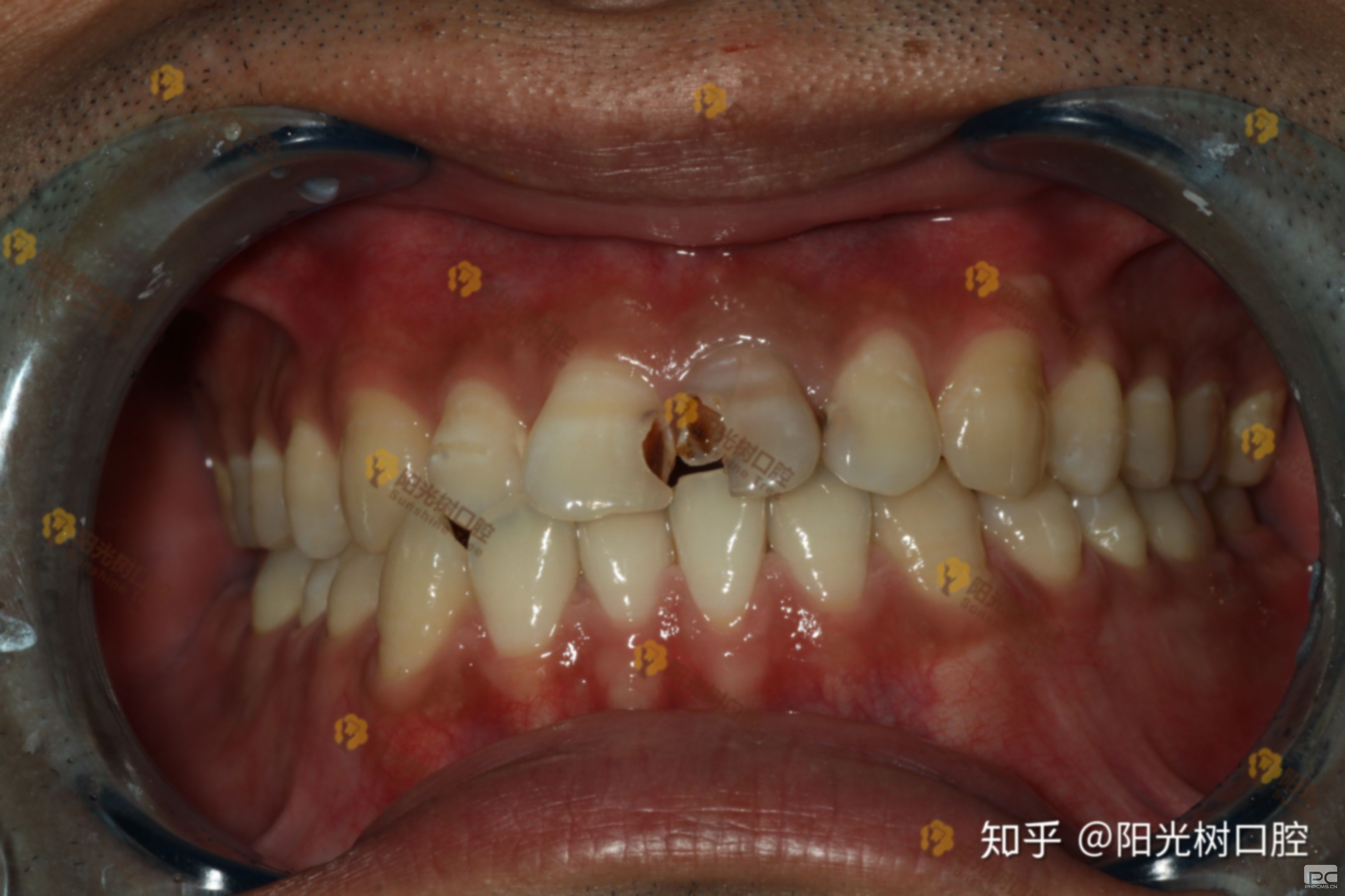 齙牙怎么做烤瓷牙?做烤瓷牙圖片,做烤瓷牙效果圖片 齙牙怎么做烤瓷牙?做烤瓷牙圖片,做烤瓷牙效果圖片