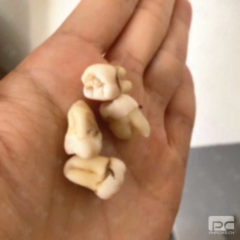 拔牙兩三年了還可以鑲牙嗎?一年了還可以鑲牙嗎?一年了還能鑲牙嗎? 拔牙兩三年了還可以鑲牙嗎?一年了還可以鑲牙嗎?一年了還能鑲牙嗎?