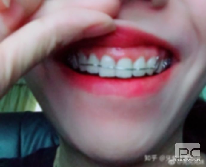 齙牙不想戴牙套怎么辦?戴牙套怎么辦?帶牙套怎么恢復(fù)? 齙牙不想戴牙套怎么辦?戴牙套怎么辦?帶牙套怎么恢復(fù)?