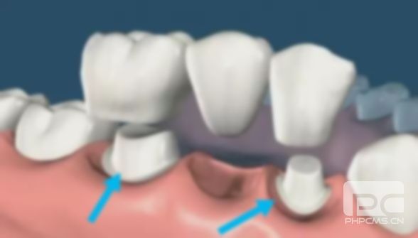 拔一顆烤瓷牙費用多少?烤瓷牙多少錢一顆?牙后做烤瓷牙多少錢? 拔一顆烤瓷牙費用多少?烤瓷牙多少錢一顆?牙后做烤瓷牙多少錢?