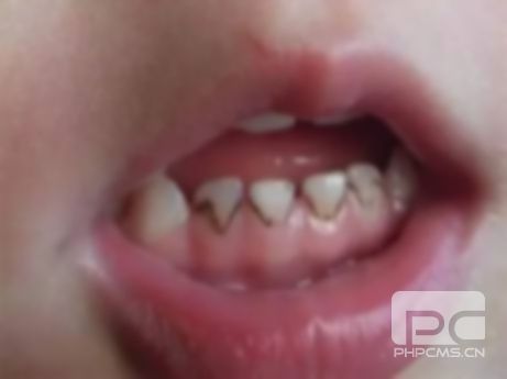 孩子牙黑了該怎么處理方法?小孩牙黑了怎么處理?的牙黑了怎么治療? 孩子牙黑了該怎么處理方法?小孩牙黑了怎么處理?的牙黑了怎么治療?