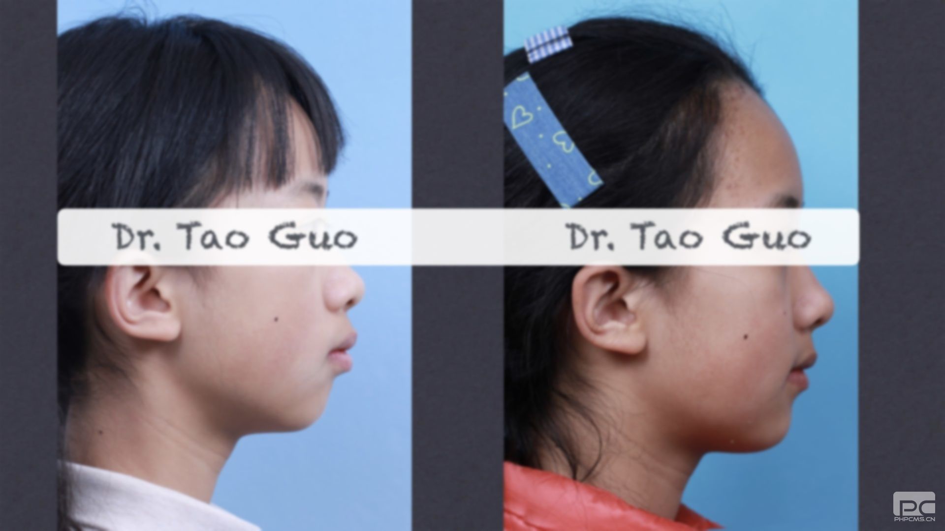 齙牙矯正之后臉型,后側(cè)臉變化,前后臉對比照 齙牙矯正之后臉型,后側(cè)臉變化,前后臉對比照